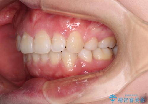 ふっくらとした口元を改善したい 目立たないワイヤー装置による抜歯矯正の治療後