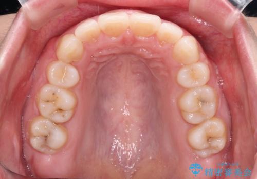 ふっくらとした口元を改善したい 目立たないワイヤー装置による抜歯矯正の治療後