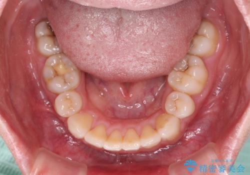 ふっくらとした口元を改善したい 目立たないワイヤー装置による抜歯矯正の治療後