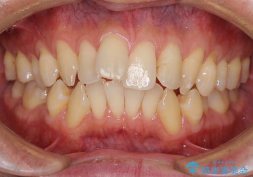 掃除しにくい前歯と閉じにくい口元　目立たないワイヤー装置での抜歯矯正の治療前