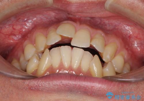 掃除しにくい前歯と閉じにくい口元 目立たないワイヤー装置での抜歯矯正の治療前