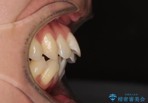 掃除しにくい前歯と閉じにくい口元 目立たないワイヤー装置での抜歯矯正の治療前