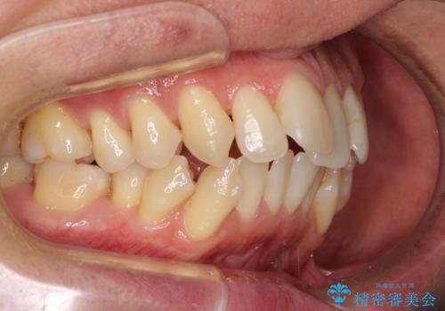 掃除しにくい前歯と閉じにくい口元 目立たないワイヤー装置での抜歯矯正の治療前