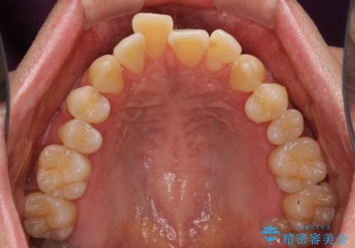 掃除しにくい前歯と閉じにくい口元 目立たないワイヤー装置での抜歯矯正の治療前