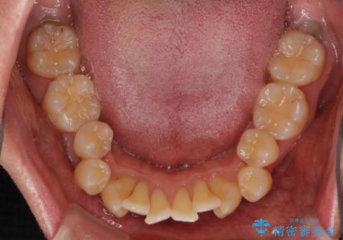掃除しにくい前歯と閉じにくい口元　目立たないワイヤー装置での抜歯矯正の治療前