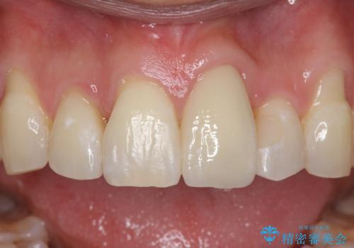 前歯の虫歯 矯正治療してからしっかり治すの治療後