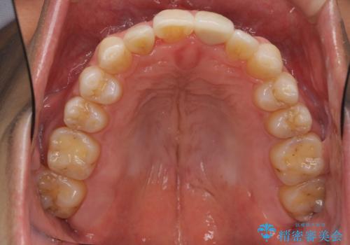 前歯の虫歯 矯正治療してからしっかり治すの治療後