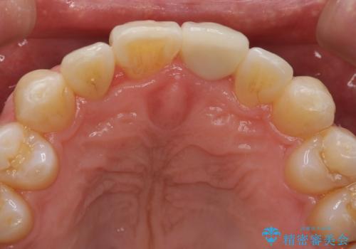 前歯の虫歯 矯正治療してからしっかり治すの治療後