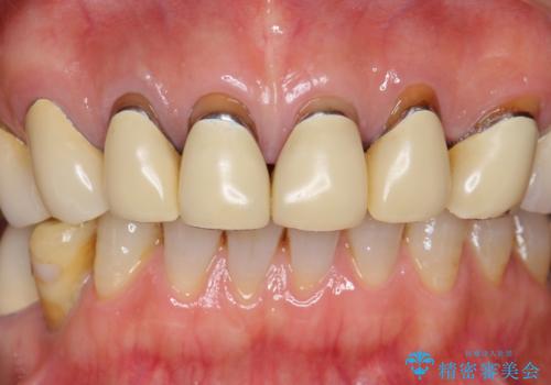 長持ちするセラミック 4年半経過症例 50代女性の治療前