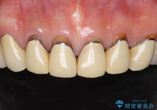 長持ちするセラミック 4年半経過症例 50代女性の症例 治療前