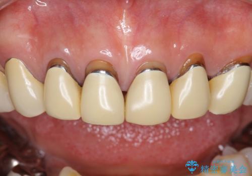 長持ちするセラミック 4年半経過症例 50代女性の治療前