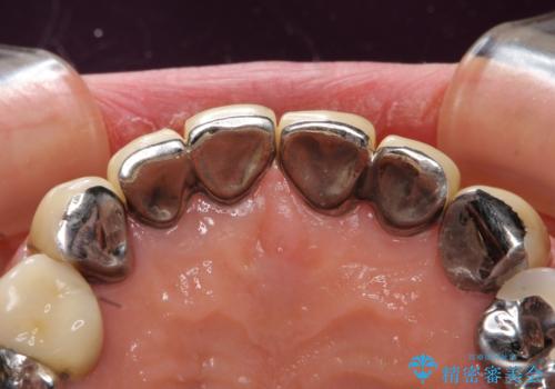 長持ちするセラミック 4年半経過症例 50代女性の治療前