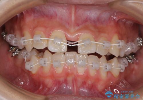 急速拡大装置で狭い歯列を骨格ごと改善 ワイヤー装置による矯正治療の治療中