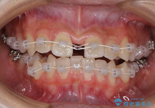 急速拡大装置で狭い歯列を骨格ごと改善　ワイヤー装置による矯正治療の治療中