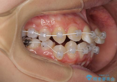 急速拡大装置で狭い歯列を骨格ごと改善 ワイヤー装置による矯正治療の治療中