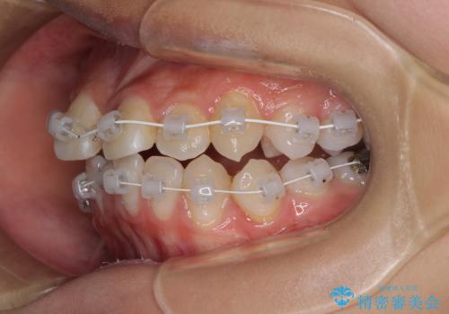 急速拡大装置で狭い歯列を骨格ごと改善 ワイヤー装置による矯正治療の治療中