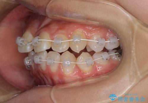 急速拡大装置で狭い歯列を骨格ごと改善　ワイヤー装置による矯正治療の治療中
