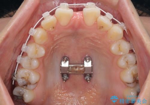 急速拡大装置で狭い歯列を骨格ごと改善 ワイヤー装置による矯正治療の治療中