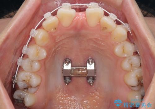 急速拡大装置で狭い歯列を骨格ごと改善　ワイヤー装置による矯正治療の治療中
