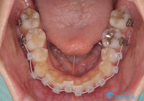 急速拡大装置で狭い歯列を骨格ごと改善 ワイヤー装置による矯正治療の治療中