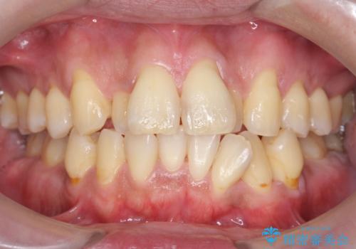 前歯の虫歯 矯正治療してからしっかり治すの治療前