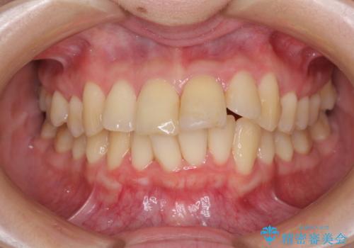 上下前歯のデコボコをきれいに インビザラインによる矯正治療の治療中