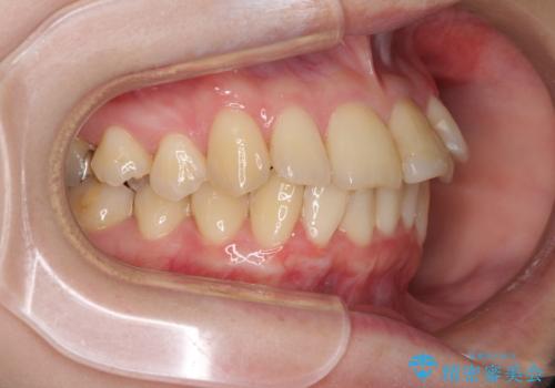 上下前歯のデコボコをきれいに　インビザラインによる矯正治療の治療中