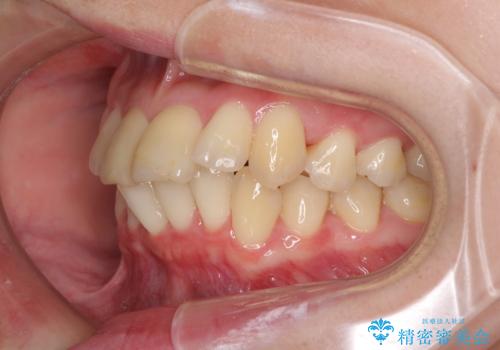 上下前歯のデコボコをきれいに インビザラインによる矯正治療の治療中