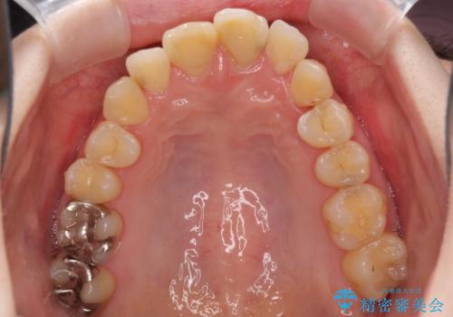 上下前歯のデコボコをきれいに インビザラインによる矯正治療の治療中