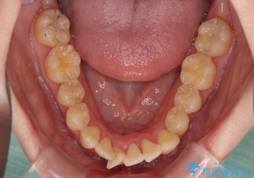 上下前歯のデコボコをきれいに インビザラインによる矯正治療の治療中