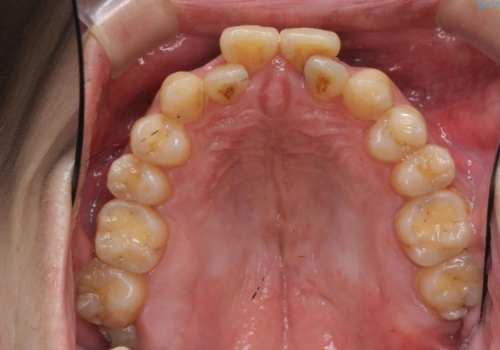 前歯の虫歯 矯正治療してからしっかり治すの治療前