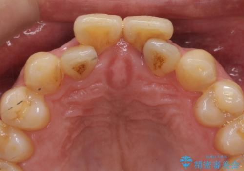 前歯の虫歯 矯正治療してからしっかり治すの治療前