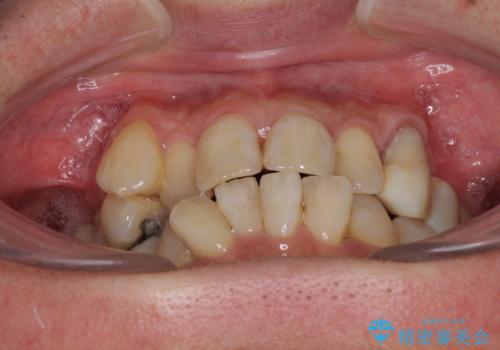 歯並びや奥歯の痛み 色々と治したい 総合歯科診療の治療前