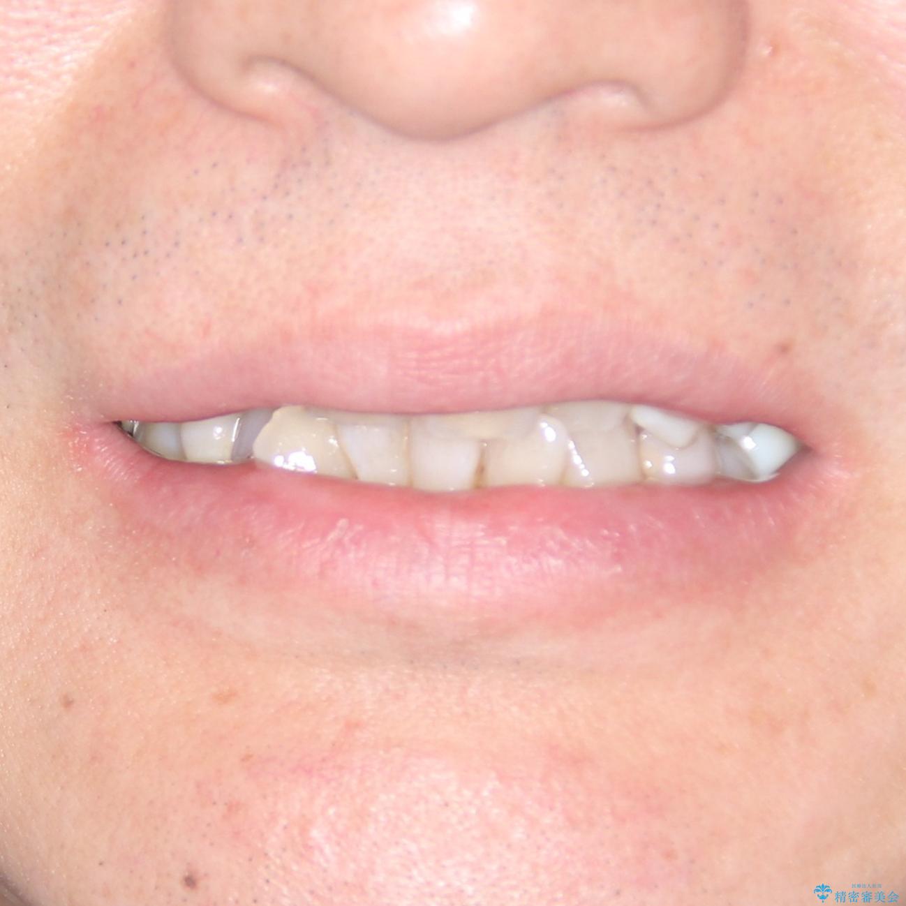 歯並びや奥歯の痛み　色々と治したい　総合歯科診療の治療前（顔貌）