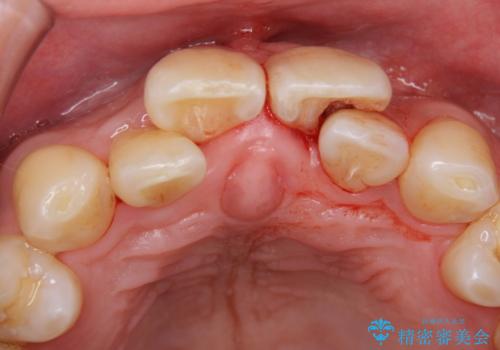 前歯の虫歯 矯正治療してからしっかり治すの治療前
