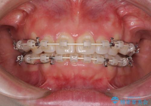 ふっくらとした口元を改善したい　目立たないワイヤー装置による抜歯矯正の治療中