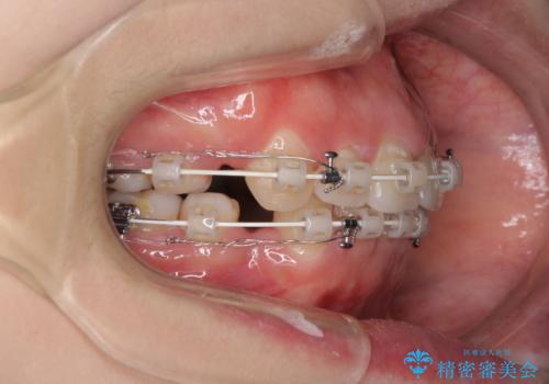 ふっくらとした口元を改善したい 目立たないワイヤー装置による抜歯矯正の治療中