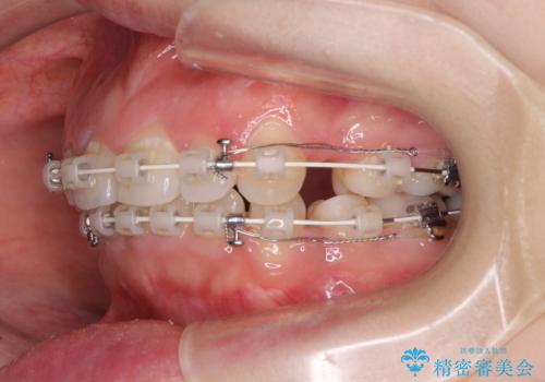 ふっくらとした口元を改善したい 目立たないワイヤー装置による抜歯矯正の治療中