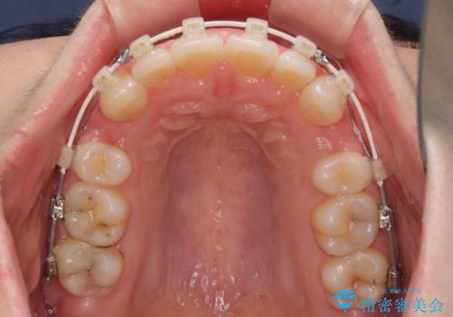 ふっくらとした口元を改善したい　目立たないワイヤー装置による抜歯矯正の治療中