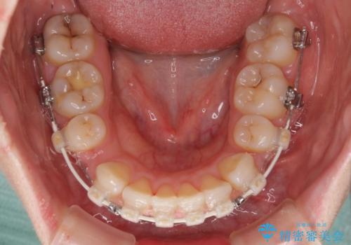 ふっくらとした口元を改善したい 目立たないワイヤー装置による抜歯矯正の治療中