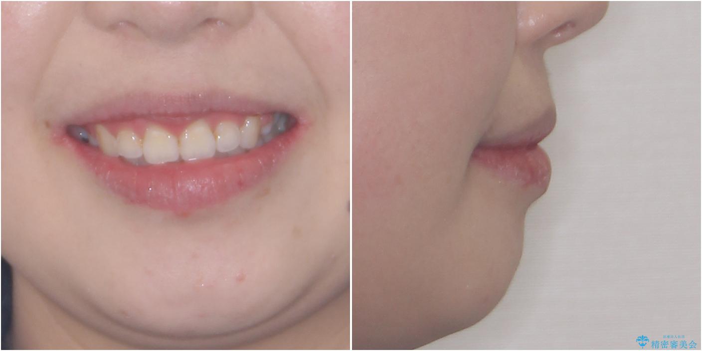 ふっくらとした口元を改善したい　目立たないワイヤー装置による抜歯矯正の治療後（顔貌）