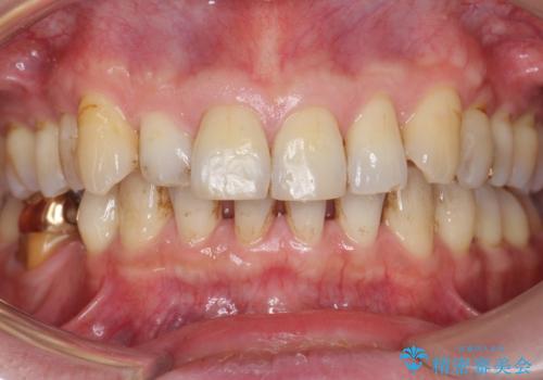 親知らずのせいで隣の歯が虫歯に 40代男性の治療前