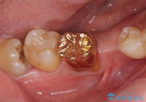親知らずのせいで隣の歯が虫歯に 40代男性の治療前