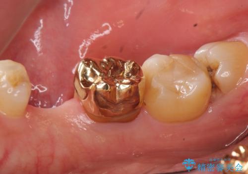 親知らずのせいで隣の歯が虫歯に 40代男性の治療前