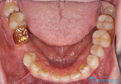 親知らずのせいで隣の歯が虫歯に　40代男性の治療前