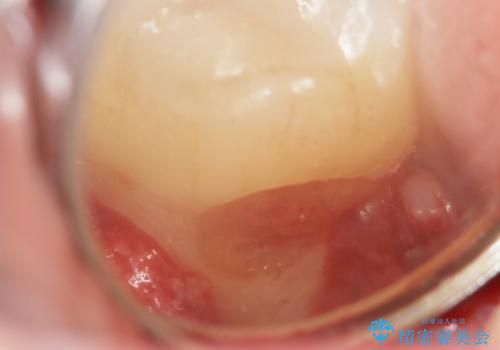 親知らずのせいで隣の歯が虫歯に 40代男性の治療後