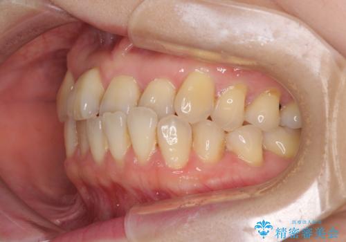前歯のクロスバイトを治したい　インビザラインによる矯正治療の治療前