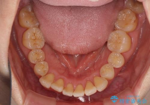 前歯のクロスバイトを治したい　インビザラインによる矯正治療の治療前