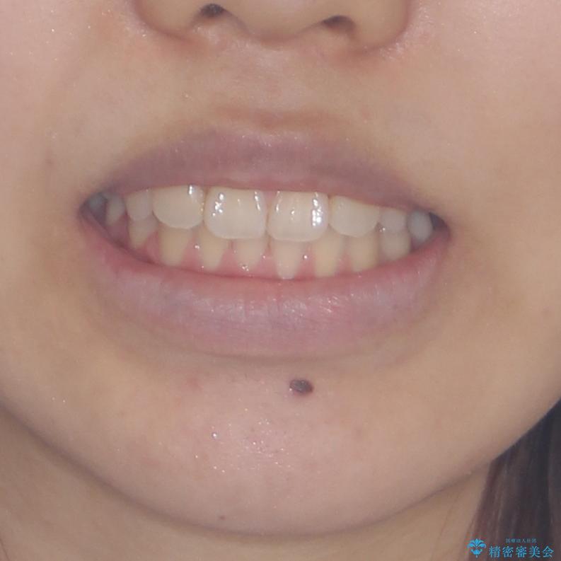 急速拡大装置で狭い歯列を骨格ごと改善 ワイヤー装置による矯正治療の治療後(顔貌)