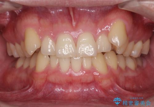 気になる八重歯を抜歯矯正で改善　補助装置を用いたインビザライン矯正の症例 治療前